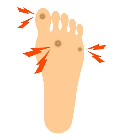 足の裏のタコ 魚の目の原因は靴の履き方 治し方は