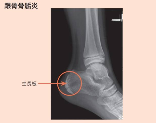 家有學齡兒童注意 腳跟痛就是 轉大人 骨科醫師提醒 別把 骨骺炎 當生長痛 良醫健康網 Line Today