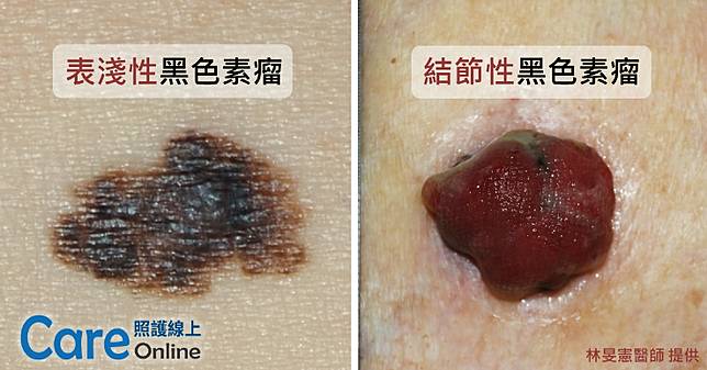 手 腳趾 腳掌冒黑痣要注意 恐是惡性皮膚癌 黑色素瘤 媽媽經 Line Today