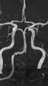 脳卒中クズ人間