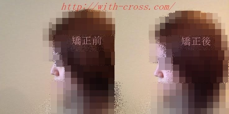 小顔矯正クロス 熊本市 Line Official Account