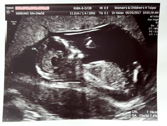 懷孕大小事 13 28週 臺北婦幼醫院初唐篩檢醫師親自上課高層次超音波終於揭曉寶寶性別 Wreadit Line Today