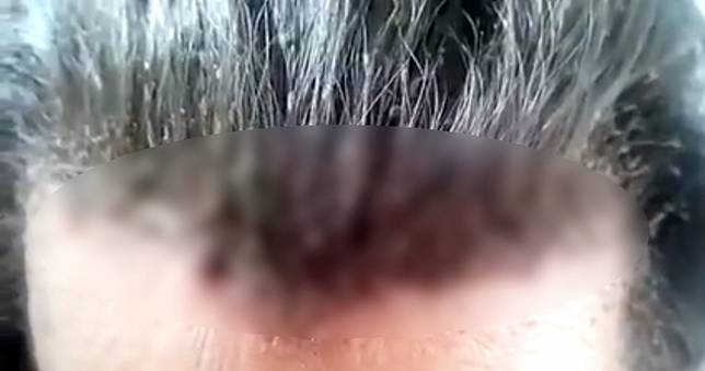 噁爆！男子髮間「上百隻頭蝨」爬竄　網崩潰喊：看了好想吐