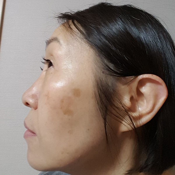 すごく痛い 顔のシミ取りレーザー体験記