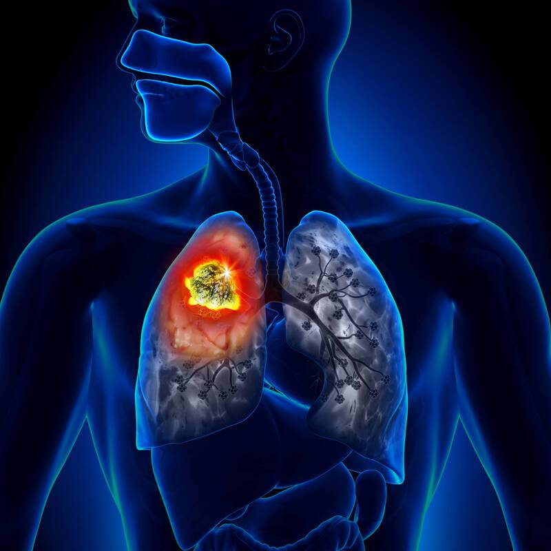 [閒聊] 肺癌首度登上國人癌症發生榜首