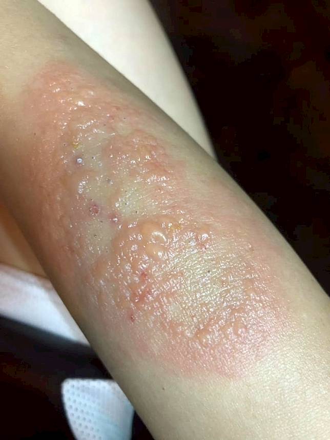 隐翅虫季节来袭 家里虫子变多 身上很多红肿伤口 没照顾好会皮肤溃烂