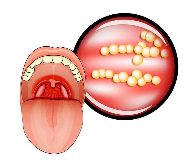 什麼是急性扁桃腺炎 常見於兒童與青少年 Hello醫師 Line Today