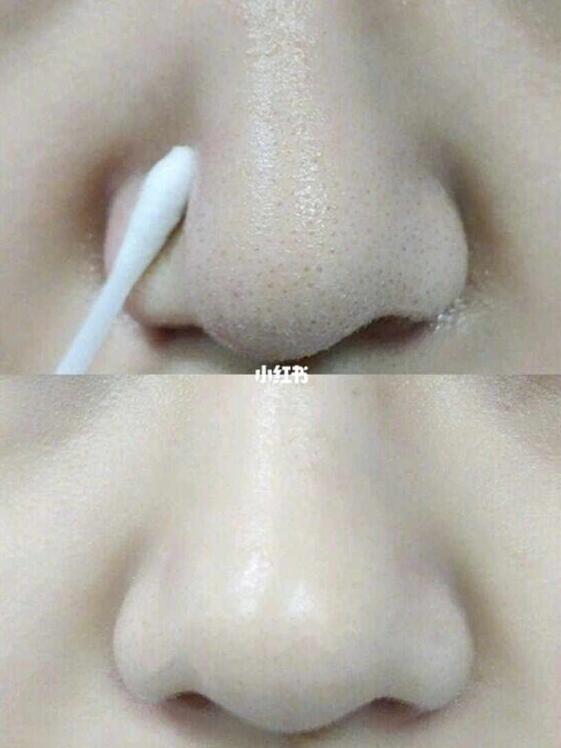 凡士林用途1：掰掰黑頭粉刺