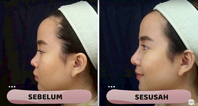 Beautyou Pengalaman Filler Hidung Selebgram Cantik Dalam Waktu 30 Menit Line Today Line Today