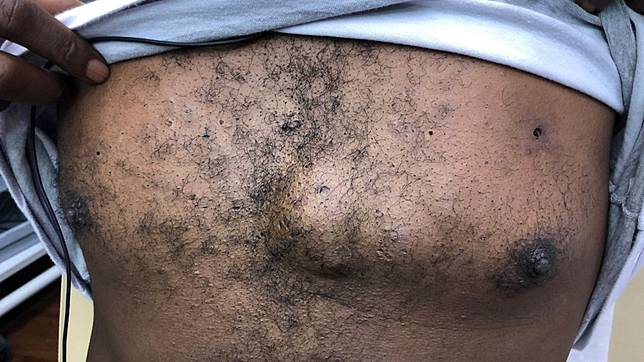 名醫手擠粉瘤山丘 香草冰淇淋爆漿 瀰漫惡臭 Tvbs Line Today