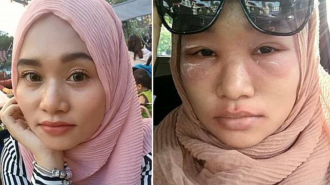 Derita Nur Sakinah, Bukan Tambah Cantik Usai Pakai Eyeshadow, Matanya Berubah Mengerikan Seperti Ini