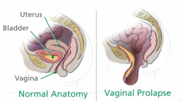 Vaginal Prolapse, Kelainan Organ Panggul yang Turun ke Vagina