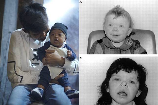 Anak Dede Sunandar Didiagnosis Williams Syndrome Kenali Lebih Jauh Penyakit Langka Itu Grid Id Line Today