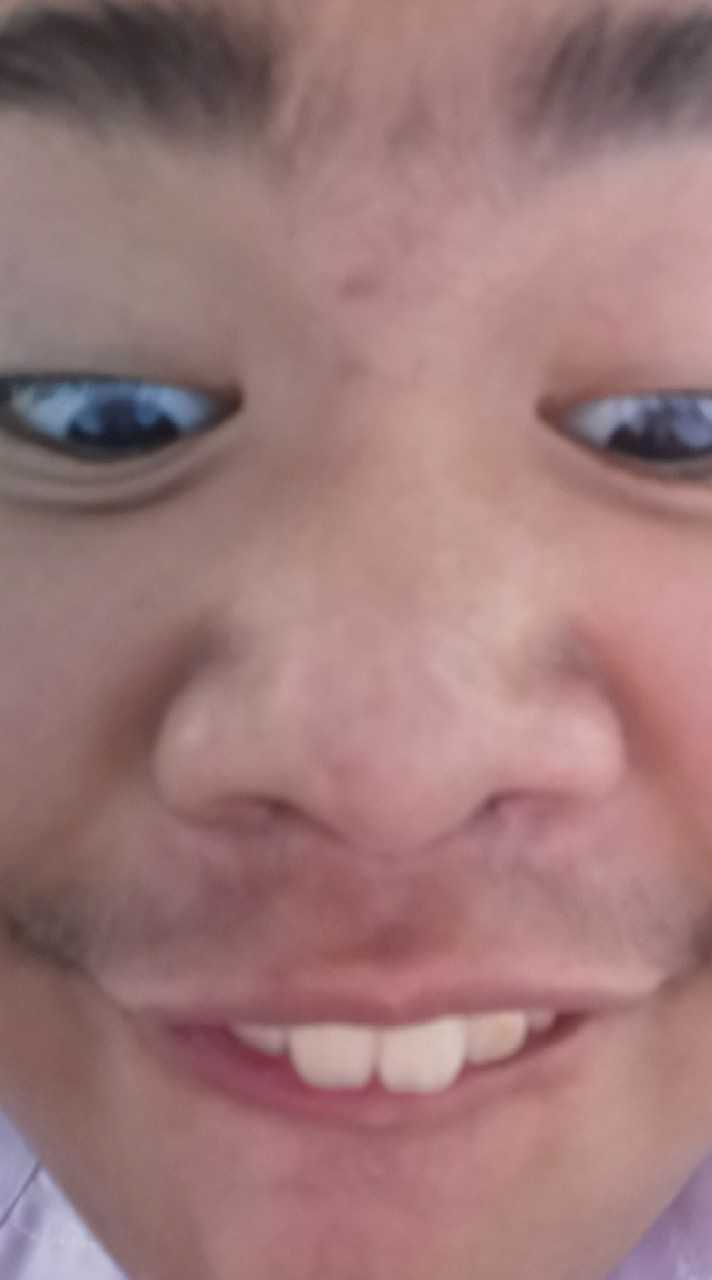 SMTE gen 2-3 Sriyapai