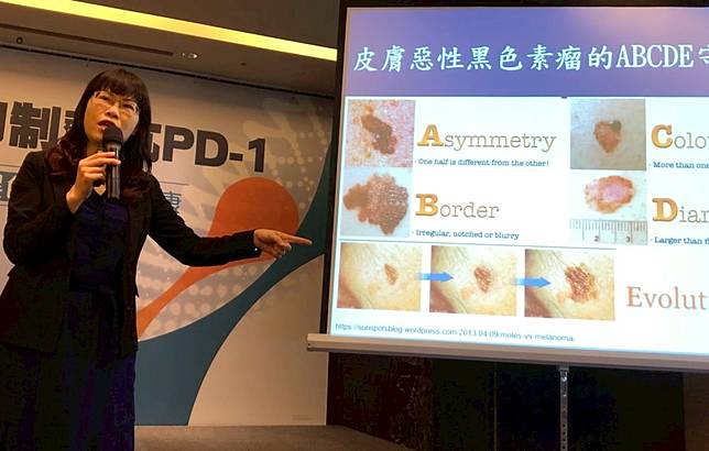 台灣人手腳掌、指甲冒「小痣」最危險！  5種壞現象恐是癌