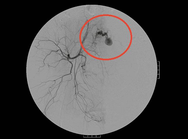 罕見！生雙胎胞滿月突大出血「流一臉盆」  送醫3次才知禍首藏子宮