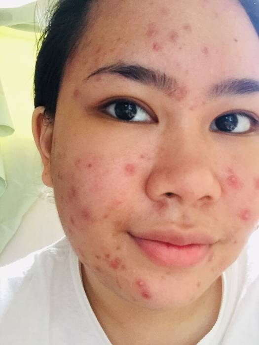 5 Jenis Jerawat Dan Cara Mengatasinya Yang Kamu Harus Tau Indozone Id Line Today