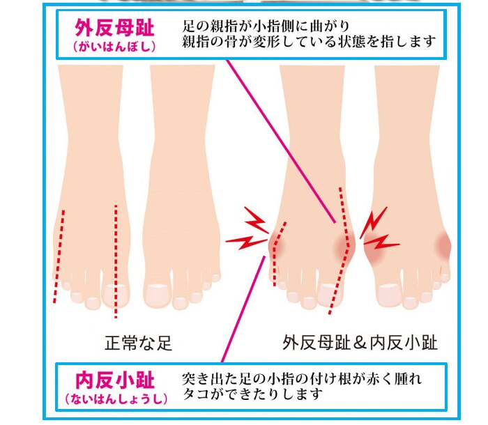 分趾器 日本腳趾矯正器大拇指外翻矯正器腳趾重疊瑜伽分趾器足外翻矯正器