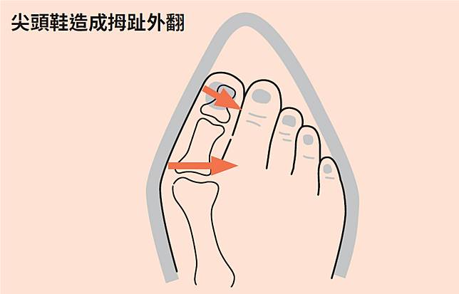 拇指外翻讓身體歪又痛！穿鞋老是磨腳，你有2種手術選擇 | Heho健康 | LINE TODAY