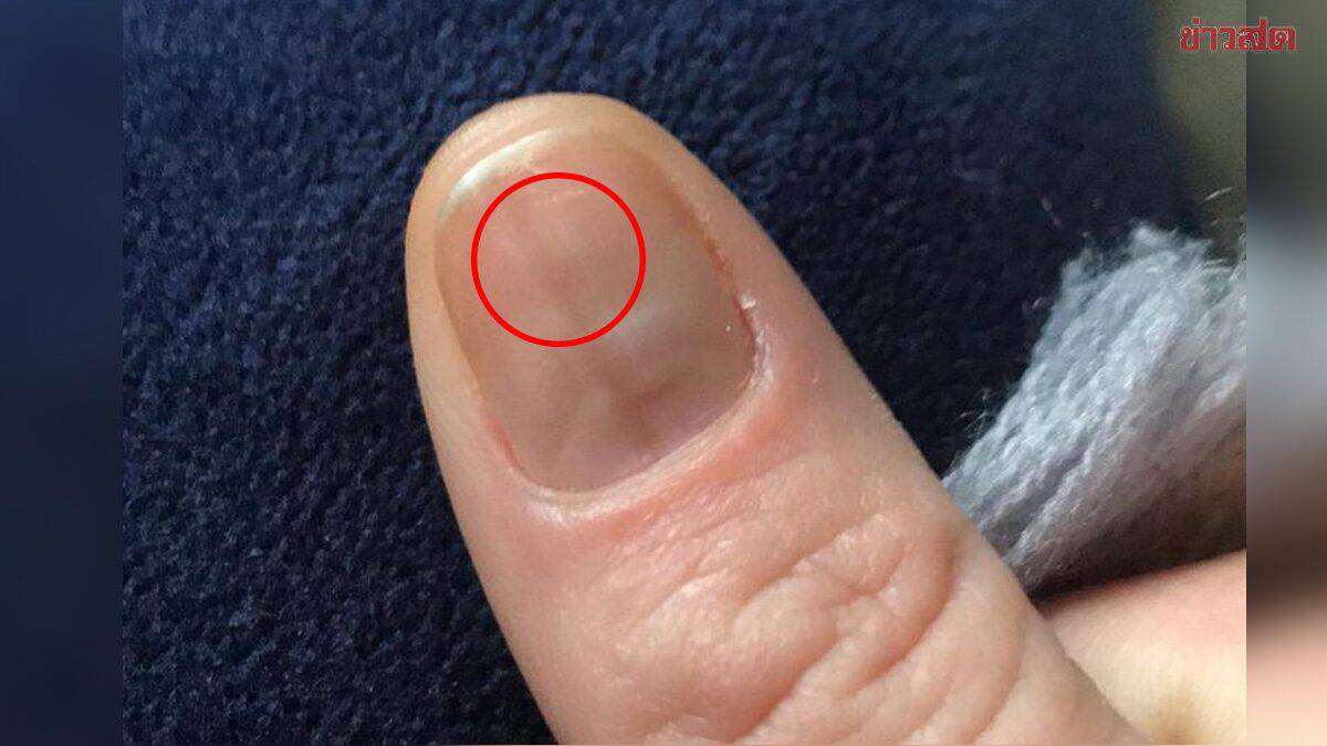 สาวงง เล็บมีรอยช้ำ ร้านทำเล็บไม่ยอมทำให้ แถมไล่ให้รีบไปรพ. ก่อนแชร์เป็นอุทาหรณ์ Khaosod LINE