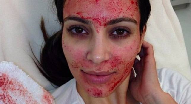 Facial Darah hingga Diet Cacing Pita, Perawatan Kecantikan Tersadis di Dunia