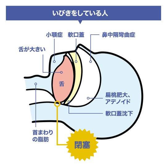 図解 危険な いびき の原因 効果的な対策 治療法