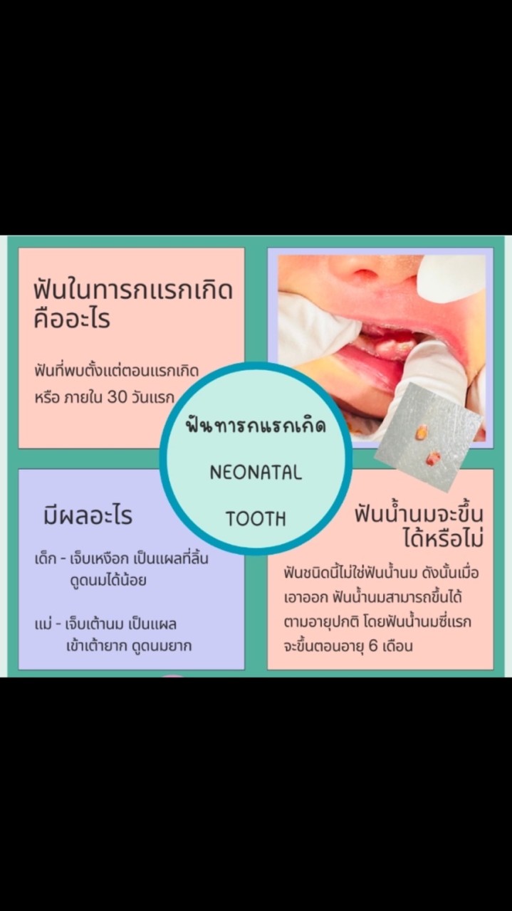 ฟันลูก