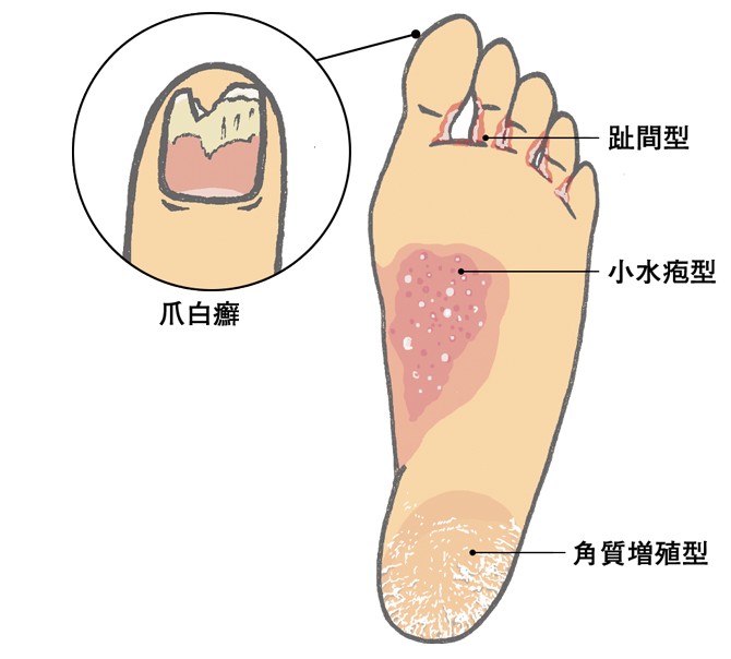 皮膚 爪の異常は足の変形のサイン 見過ごしてはいけない 足 トラブル