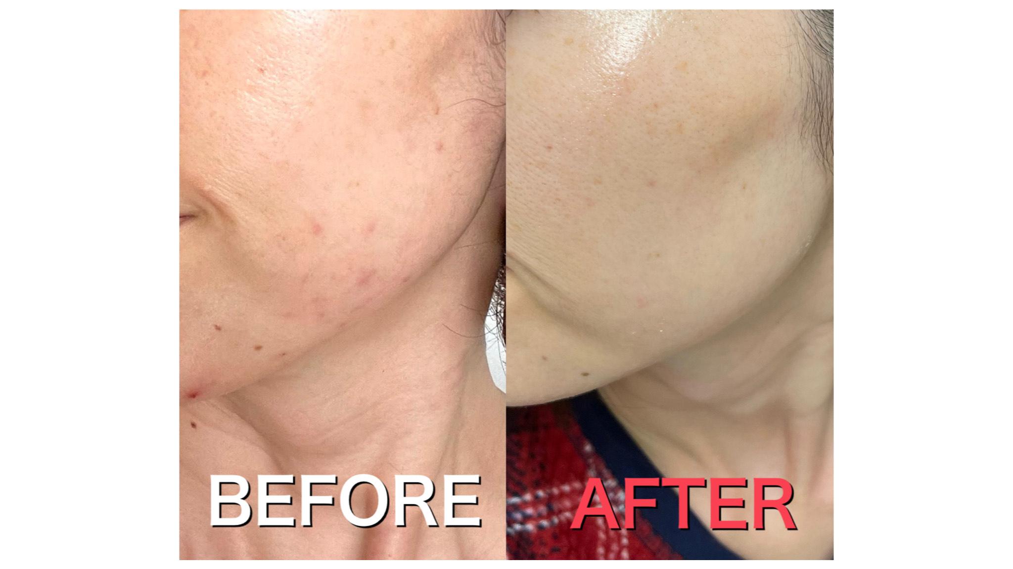 毛穴 ニキビ跡改善に期待 お金をかけず自宅で美肌を手に入れる方法 Charmmy