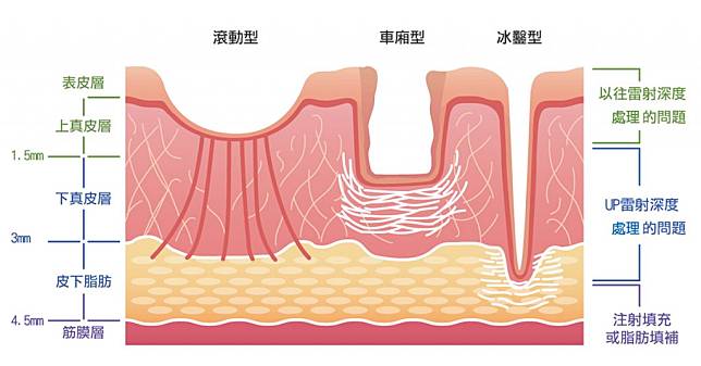 痘疤難治療 皮膚科醫師提醒深淺度影響治療選擇 Nownews 今日新聞 Line Today