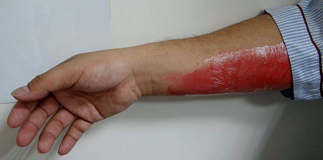 天冷吃火鍋燒燙傷快「冰敷」、「抹藥膏」？  醫護要你千萬別這樣做