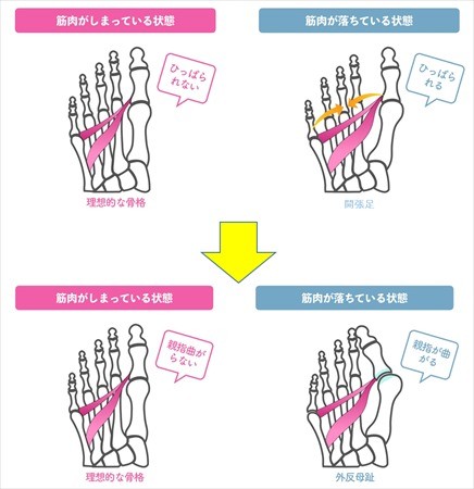 外反母趾対策に効果的な足指ストレッチ ひろのば体操