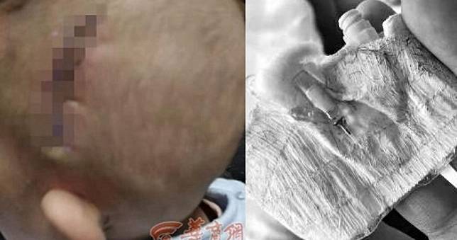 男嬰頭插針管4天後「斷裂在體內」！「不定時炸彈」1年仍未找到