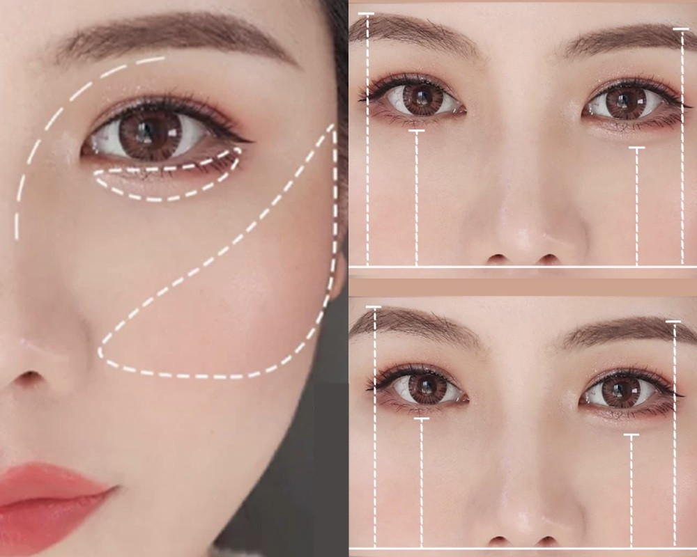 中庭長、顴骨高修容位置：顴骨、眼窩山根、眼下