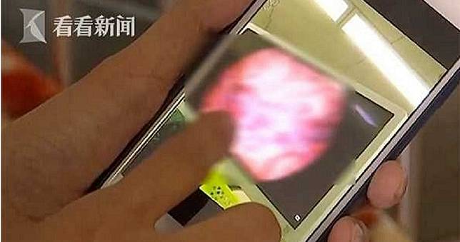 男童患罕病瘋狂流「半桶鮮血」　母割肝救兒：為了他我什麼都願意做！
