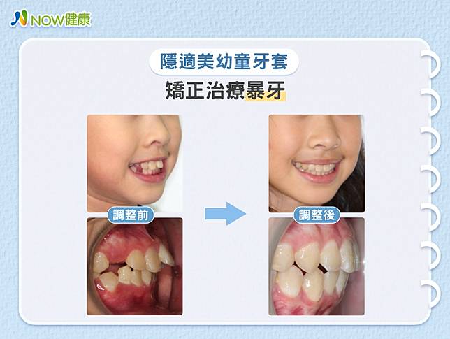 把握矯正齒列不正與戽斗的黃金時期！醫師分析治療趨勢