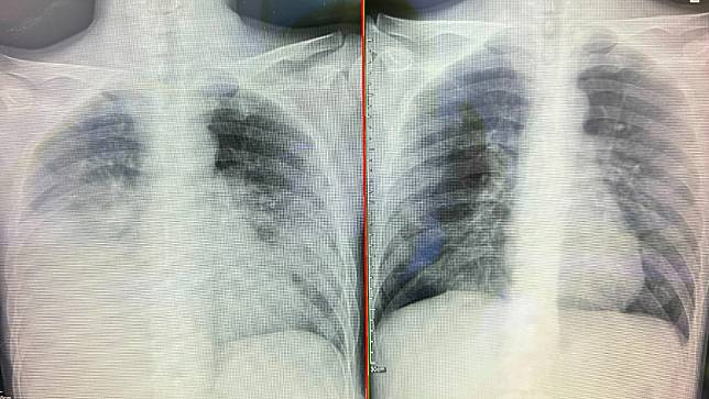 東山鴨頭楊老闆的肺部，治療前是兩側白肺(圖左)，治療後已經明顯改善。烏日林新醫院提供