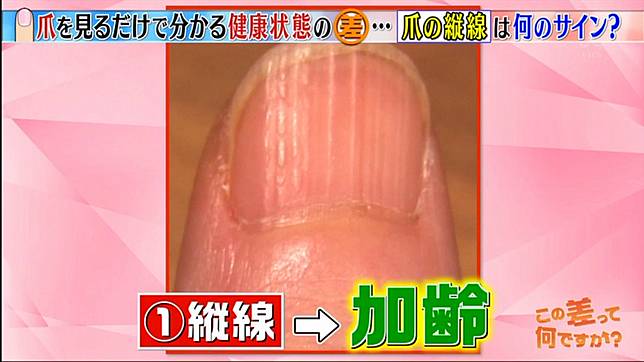 直紋 黑點 向外生 日本專家分析六種指甲特徵和健康關係 日本集合 Line Today