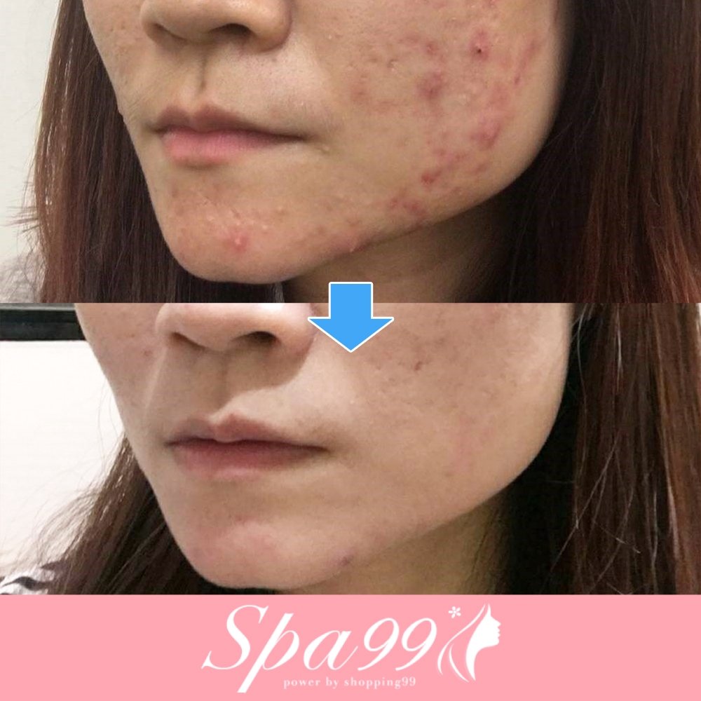 痘疤?粉刺?油光?通通擊退!打造無瑕嫩肌!反孔計畫!☑手工清粉☑微晶藻針☑精華超導☑毛孔收斂=購買說明=1. 每人最多限用1張課程券，男女性皆可使用。優惠期間到2020/09/30止。逾期需補差額。(