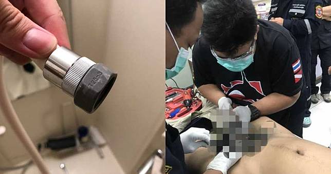 求刺激！男拿「螺旋配件DIY」　慘卡5天臭爛…GG整根切除