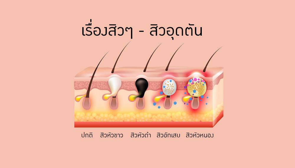 สิวหัวขาว