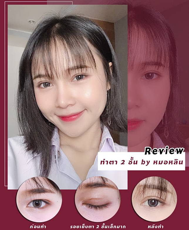 Akeru Feed | รีวิวทำตาสองชั้น Big Eye Surgery ทำที่ไทย แต่ได้ชั้นตาแบบสาว เกาหลี!