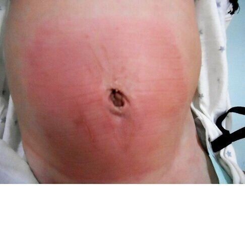 たかが されど でべそ 臍ヘルニアは早期治療で治る