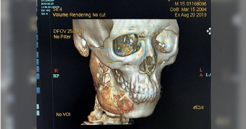 15歲少年牙痛忍1年就醫驚見下顎被 吃掉一大半 Ctwant Line Today