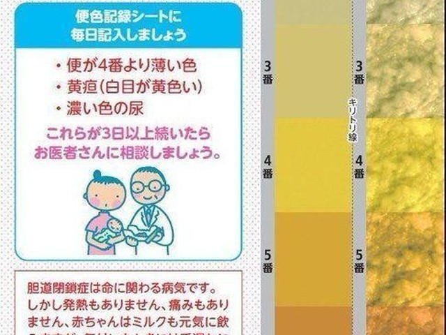便の色が手がかり 難病 胆道閉鎖症 見逃しを防ぐには たまひよ Online