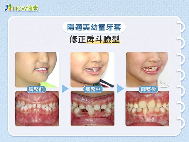 把握矯正齒列不正與戽斗的黃金時期！醫師分析治療趨勢