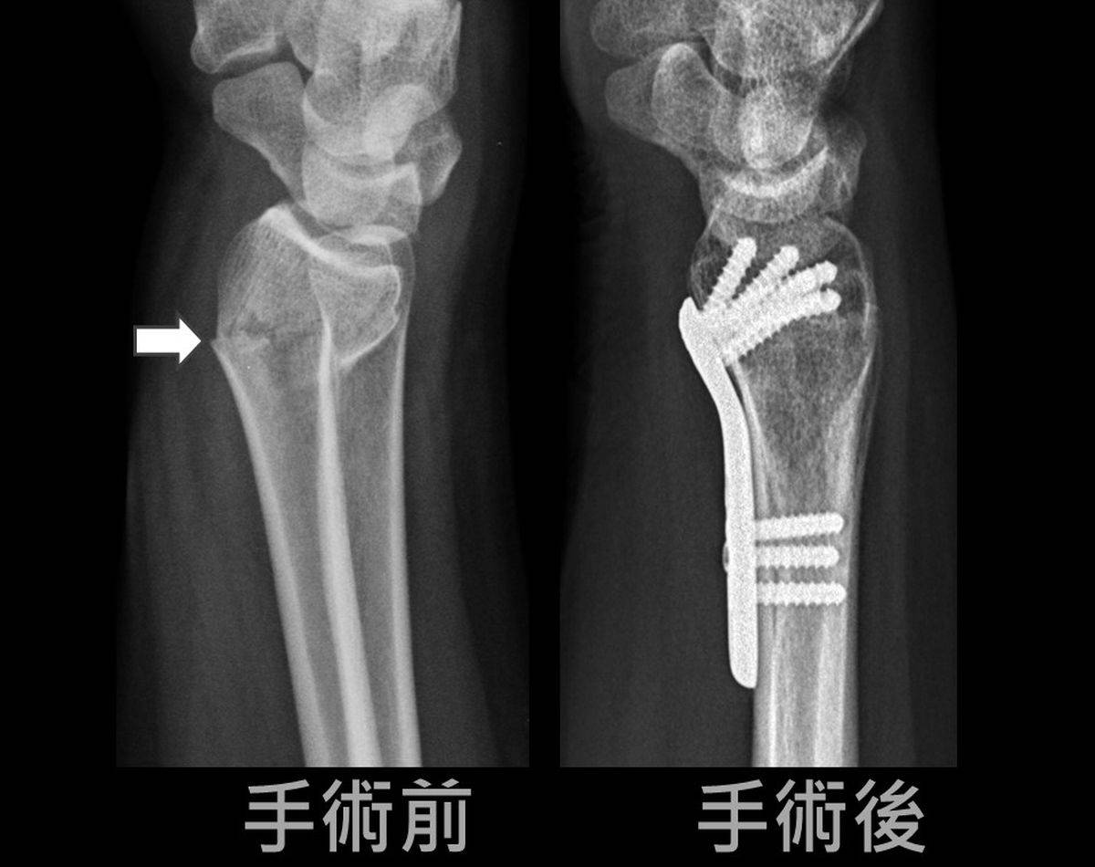 母愛噴發孕婦清醒局麻手術治斷手 中廣新聞網 Line Today