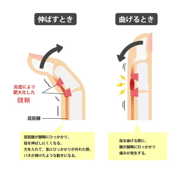 医師監修 40代 60代の女性に多いばね指の原因 症状とは