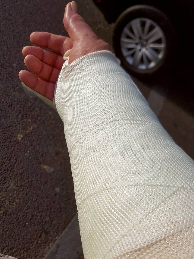 Ilustrasi Patah Tulang (Unsplash.com)