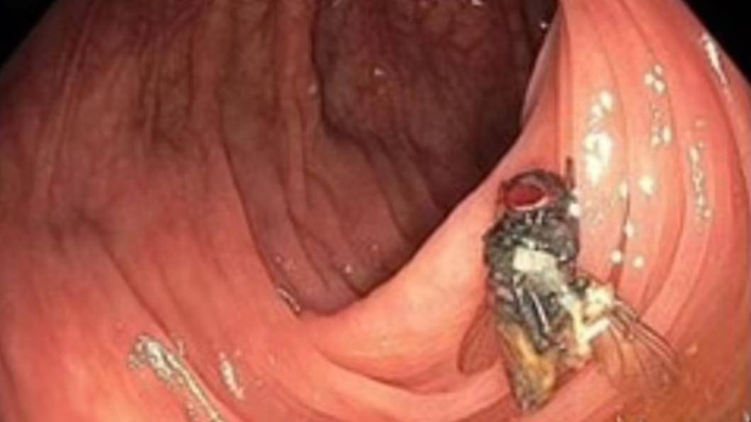 A man’s colonoscopy revealed “complete flies in his abdomen.” It was suspected that maggots were hidden in vegetables and grew into adult worms in his stomach | TVBS | LINE TODAY